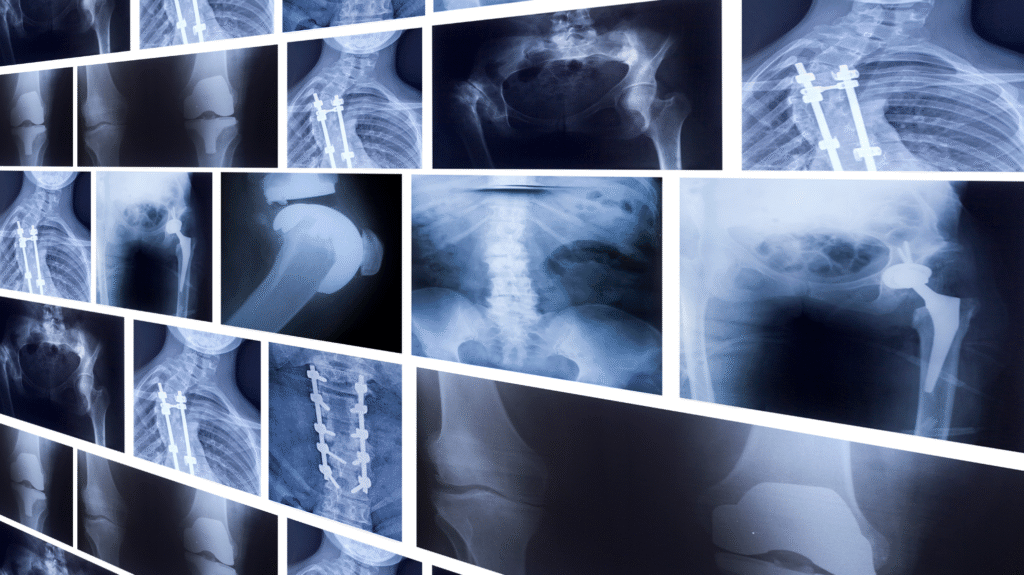 Multiple X-ray images of bones, joints, and spine showing fractures, implants, and orthopedic conditions for medical imaging analysis